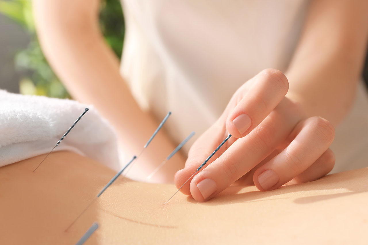 Natural Solutions for Holistic Wellness: Acupuncture for Managing Pain, Stress, and Aging