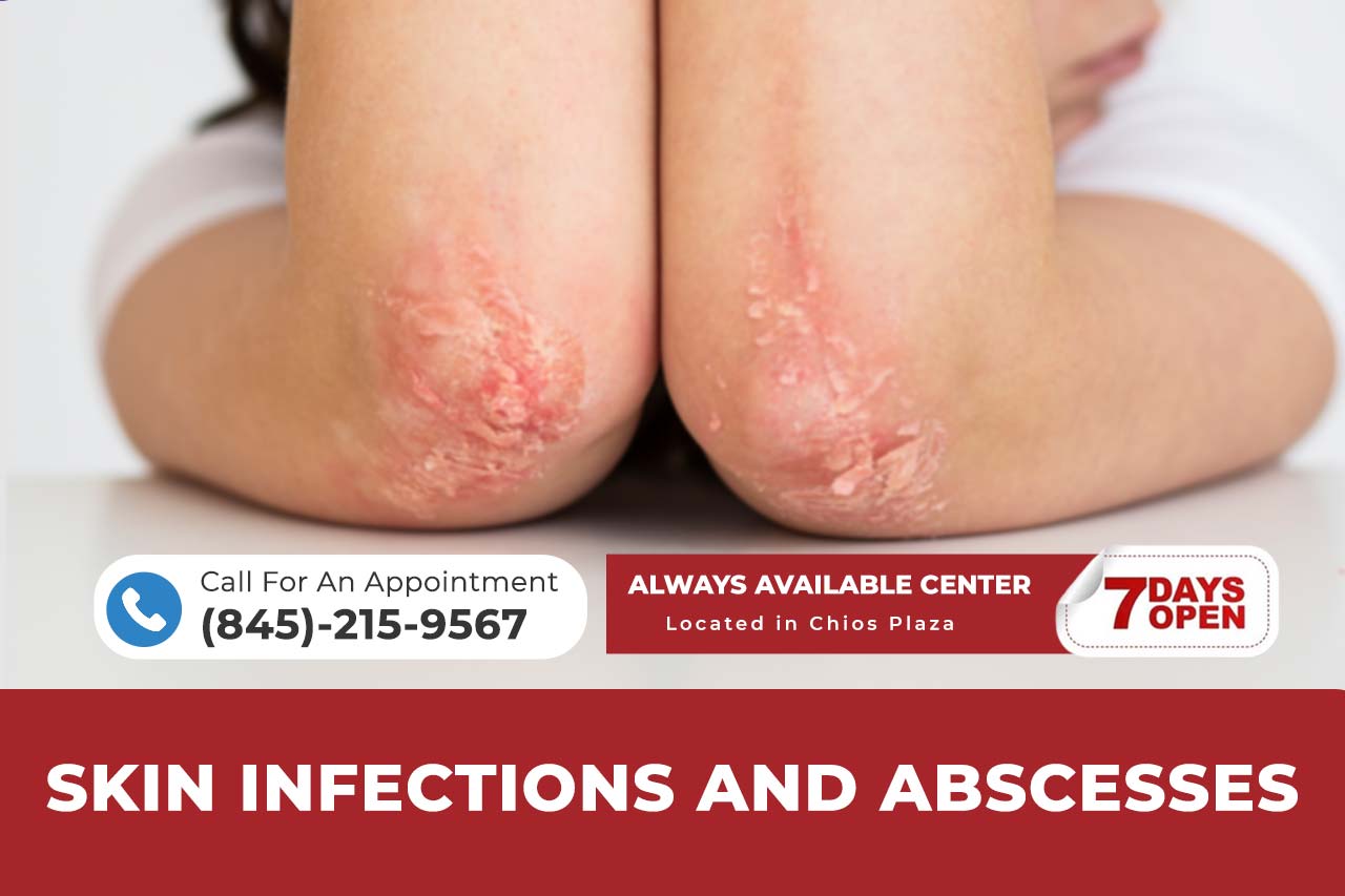 Skin Infections and Abscesses